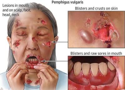 پمفیگوس چه بیماری پوستی ای است و شیوه تشخیص و درمان آن پمفیگوس چه بیماری پوستی ای است و شیوه تشخیص و درمان آن